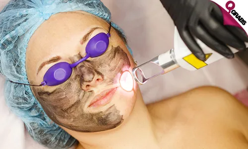 Carbon Laser Facial Treatment!